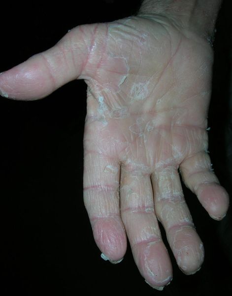 Эксфолиативный кератолиз [24]