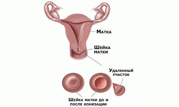 Дисплазия шейки матки 1 степени: причины, симптомы, диагностика и лечение легкой дисплазии