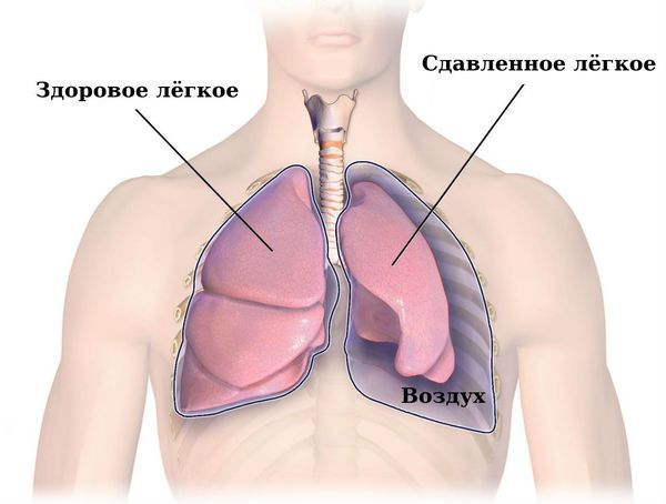 Сдавление лёгкого при спонтанном пневмотораксе Сдавление лёгкого при спонтанном пневмотораксе