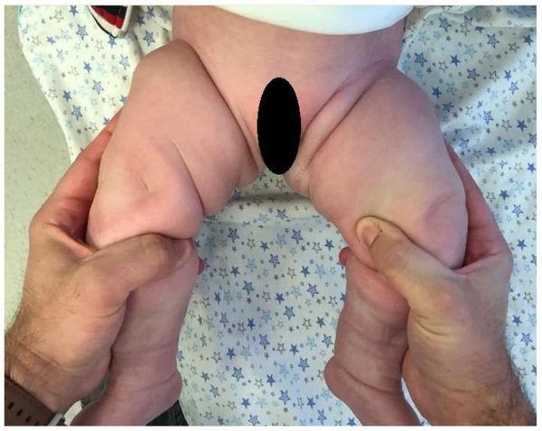 Асимметрия складок на бёдрах [13]