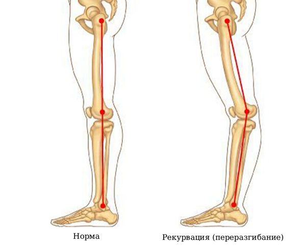 Переразгибание в коленных суставах