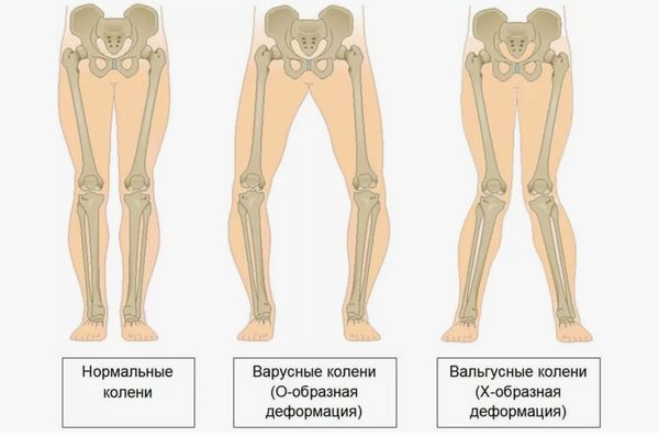 Вальгусная (Х-образная) и варусная (О-образная) деформации коленных суставов
