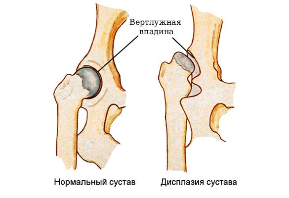Вертлужная (ацетабулярная) впадина в норме и при дисплазии
