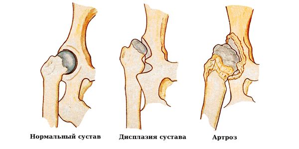 Здоровый сустав, дисплазия и артроз