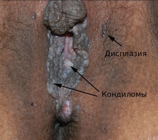 Дисплазия вульвы [23]