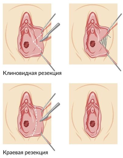 Пластика малых и больших половых губ