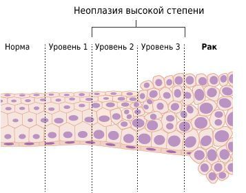 Стадии интраэпителиальной неоплазии