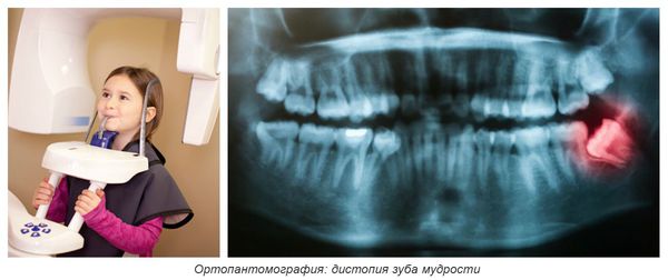 Ортопантомография: дистопия зуба мудрости