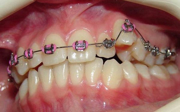 Репозиция дистопированного зуба с помощью брекет-системы