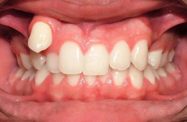 Зуб, растущий вне зубной дуги