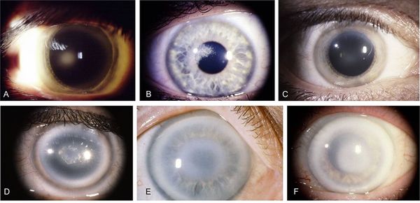 Помутнение роговицы при дистрофии Шнайдера [18]