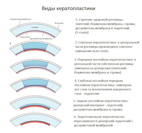 Виды кератопластики