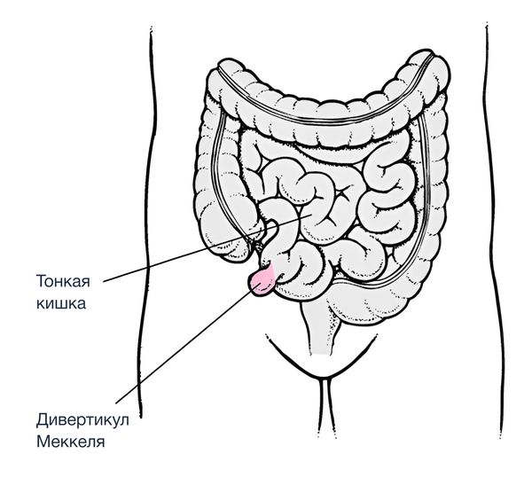 Дивертикул Меккеля