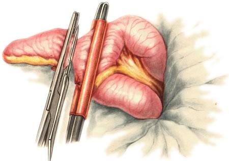 Отсечение дивертикула при открытой операции