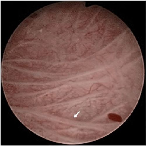 Трабекуляция [37]