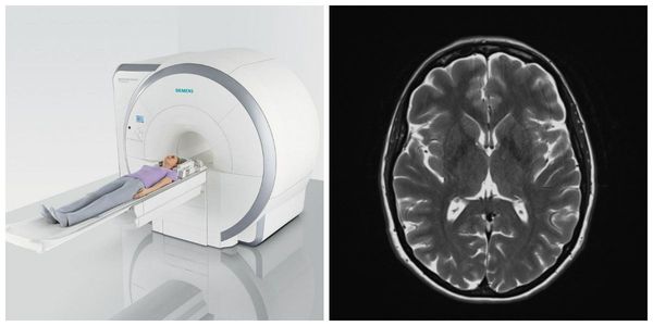 МРТ головного мозга