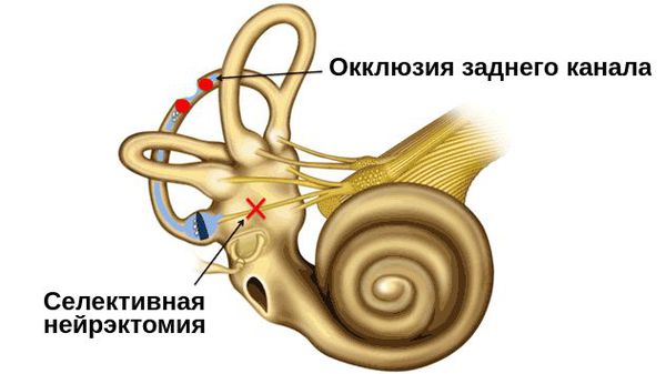 Хирургическое лечение ДППГ