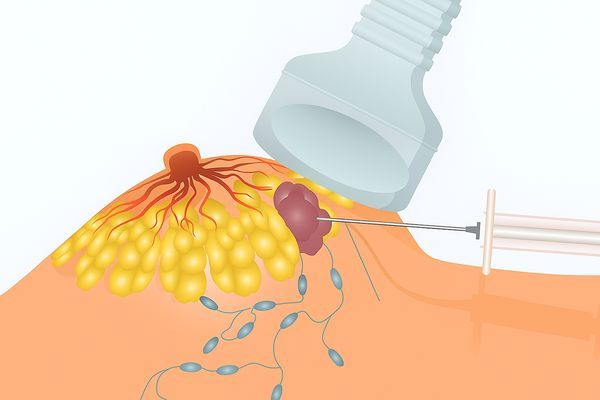 Биопсия молочной железы под контролем УЗИ