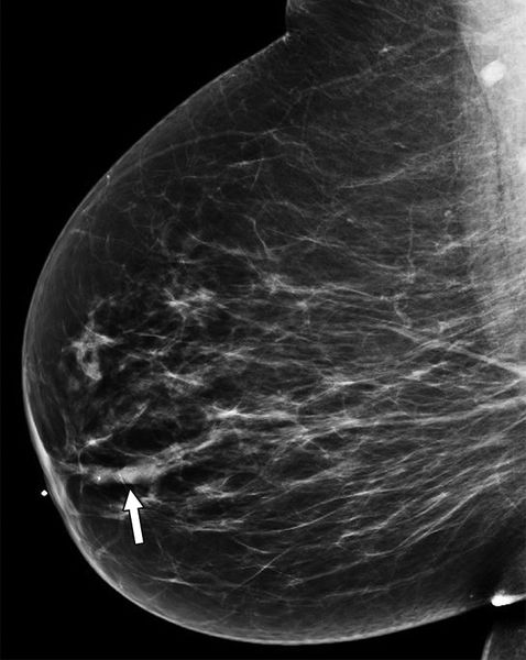 Расширенный молочный проток на маммограмме [6]