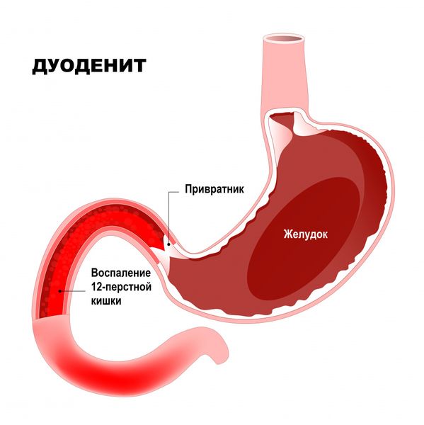 Дуоденит