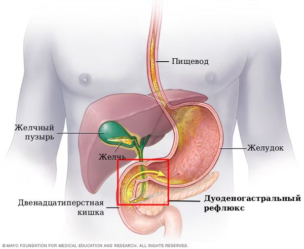 Дуоденогастральный рефлюкс [24]