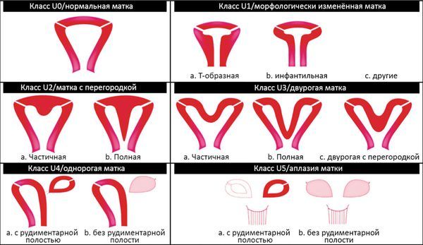 Классификация ESHRE/ESGE