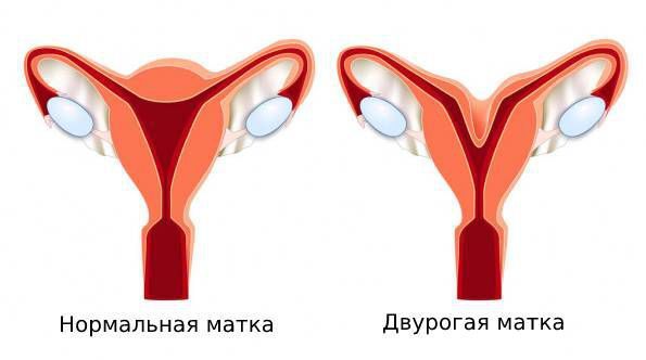 Нормальная и двурогая матка