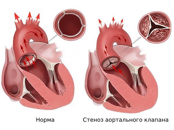 Аортальный стеноз