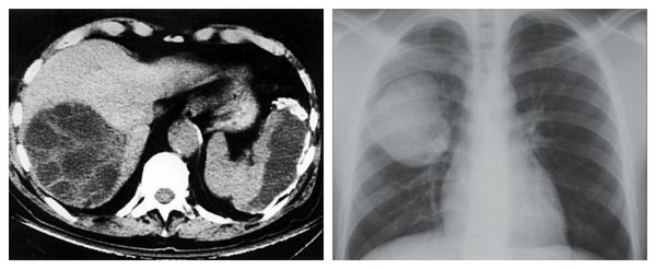 МРТ-снимок эхинококкоза печени и флюорография лёгких с эхинококковой кистой