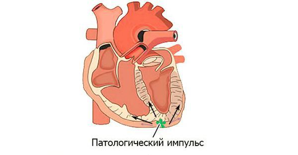 Желудочковая экстрасистолия