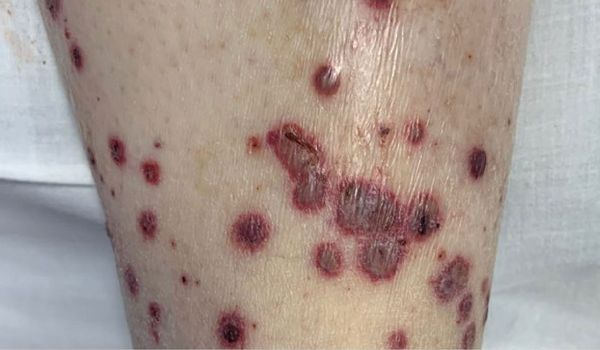 Гангренозная эктима [13]