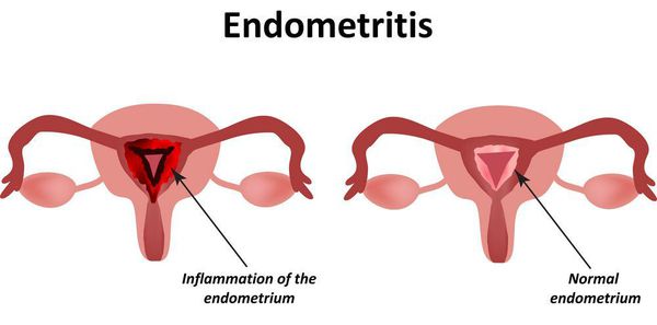 Эндометрит