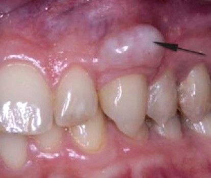 Экзостоз верхней челюсти [12]