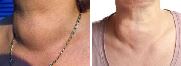 Эстетический дефект при эндемическом зобе [31]