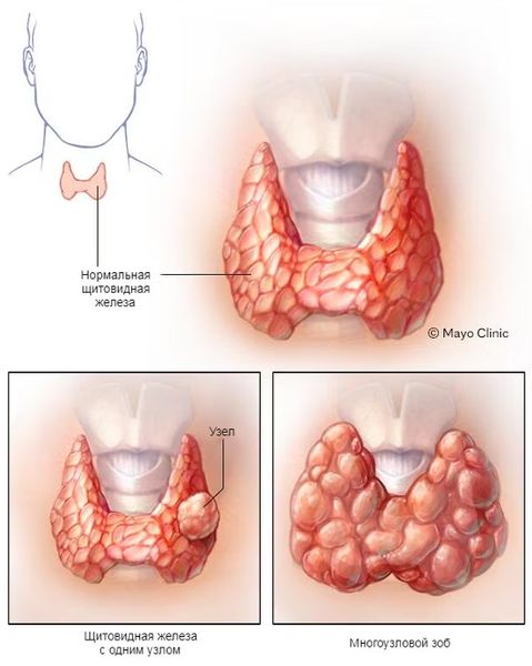 Щитовидная железа с одним узлом и многоузловой зоб Щитовидная железа с одним узлом и многоузловой зоб
