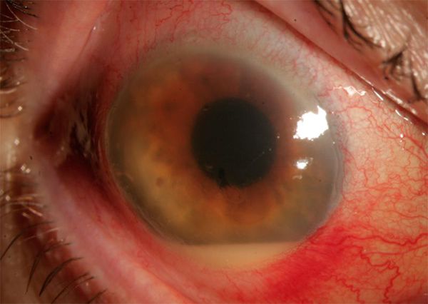 Скопление гноя и покраснение глаза при эндофтальмите