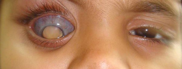 svechenie zrachka pri retinoblastome s