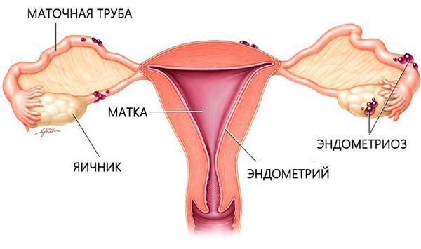 От чего бывает эндометриоз у женщин 16