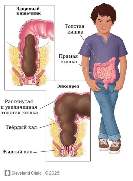 Энкопрез на фоне запора [15]