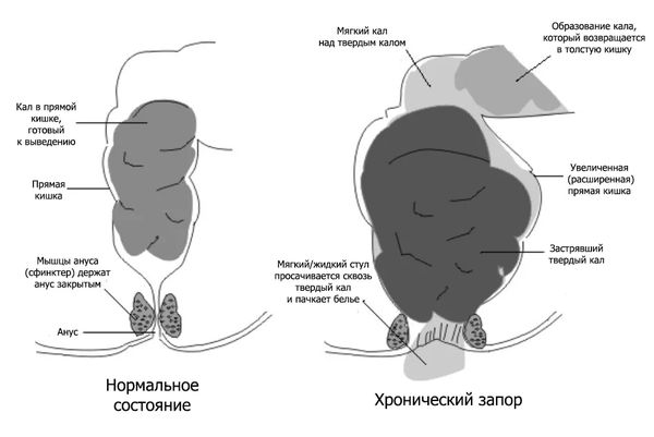 Развитие энкопреза на фоне запора