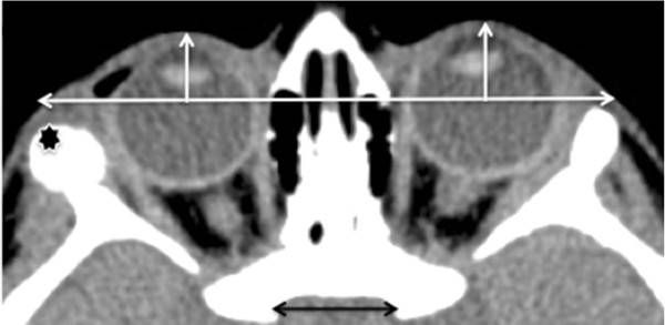 Энофтальм правого глаза на КТ [22]