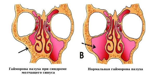 Гайморова пазуха при синдроме молчащего синуса и в норме [21]