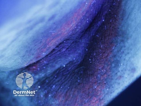 Эритразма, подсвеченная лампой Вуда [20]
