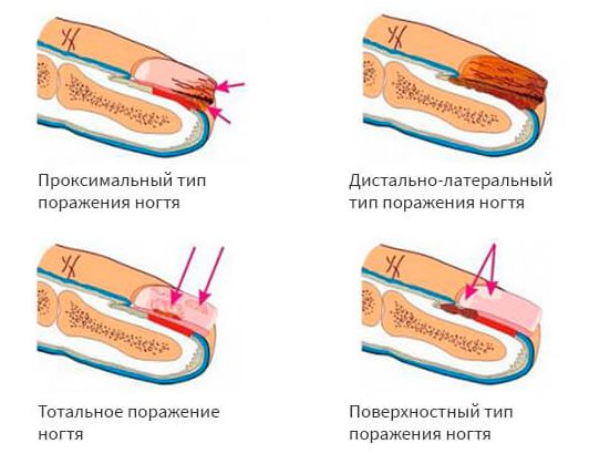Виды онихомикоза