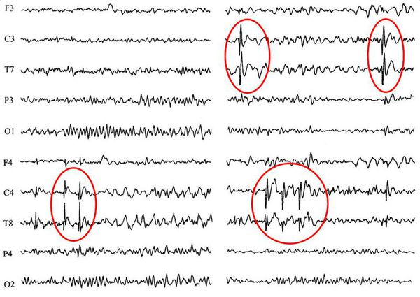 Пример данных ЭЭГ: красными кругами выделены зоны патологической эпилептиформной активности