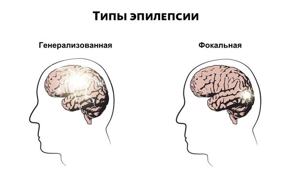 Приобретенная эпилепсия на фоне алкоголизма