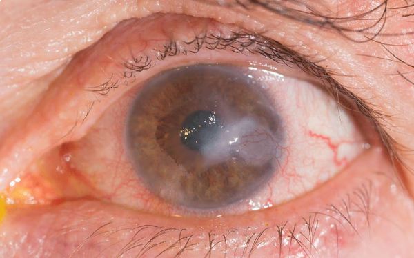 Инфильтрат роговицы [14]