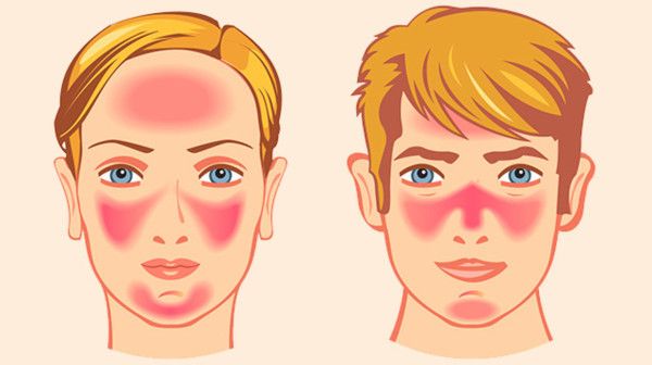 Покраснение лица