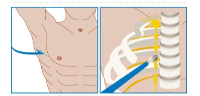 Симпатэктомия