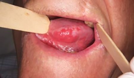 Эритроплакия [13]